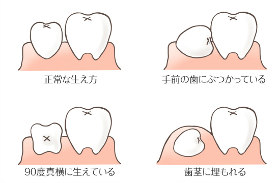 比較写真あり 親知らずを抜くと小顔になるの