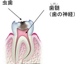 根管治療 歯根治療 ってなに 回数は 痛みは 札幌歯科 札幌の世界標準のインプラント歯医者