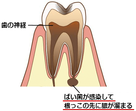 歯 神経 抜い て も 痛い